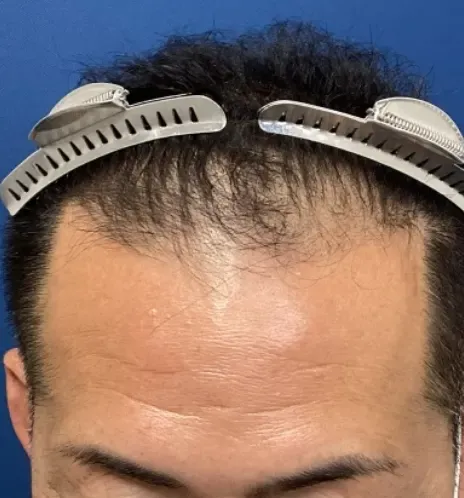 ゴリラクリニック 千葉院の症例写真