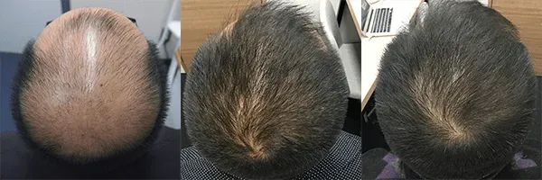 AGAヘアクリニック 大宮院の症例写真