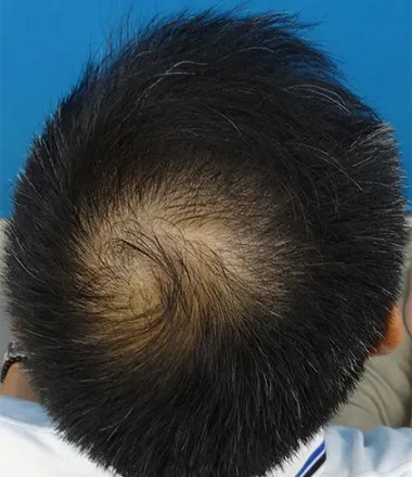 TCB東京中央美容外科の症例写真治療前