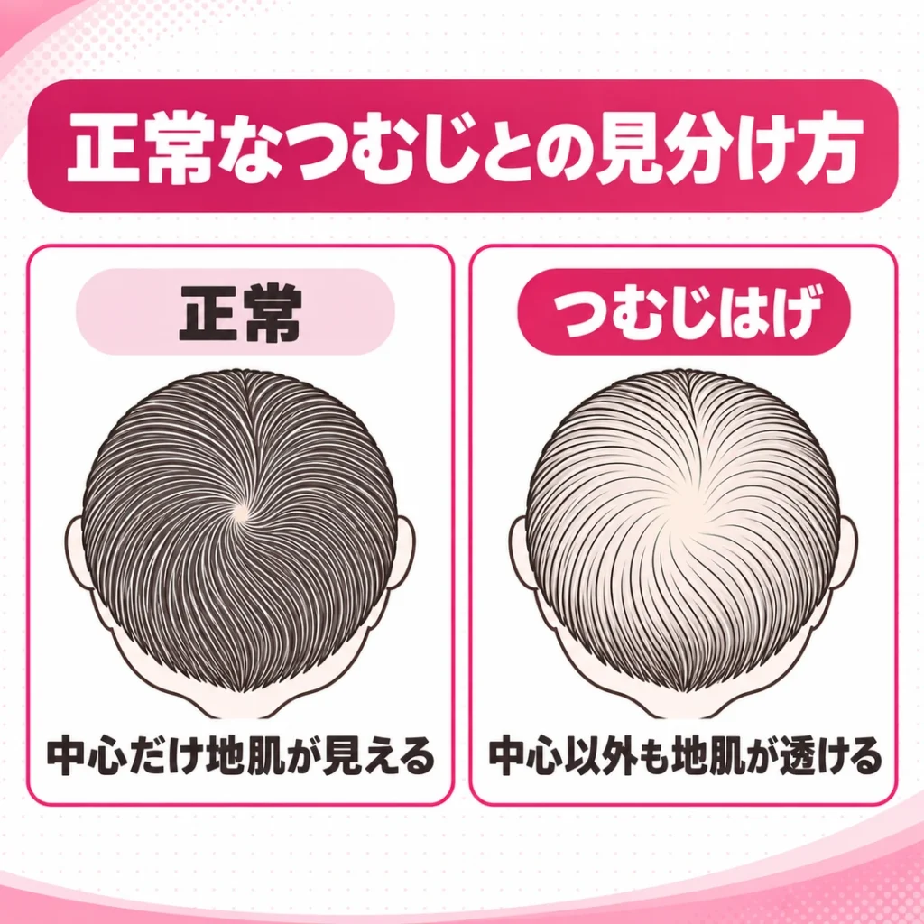 正常なつむじとつむじはげの見分け方の比較図。正常は中心だけ地肌が見え、つむじはげは中心以外でも地肌が透ける。