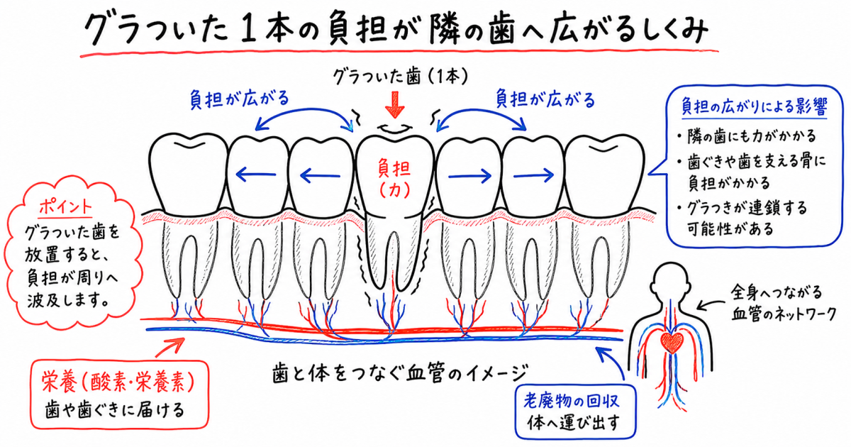 歯がグラグラする原因とは?歯周病で顎の骨(歯槽骨)が溶けるメカニズム