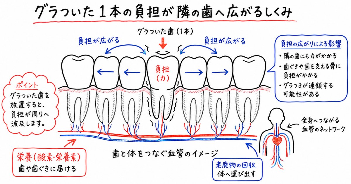 歯がグラグラする原因とは？歯周病で顎の骨（歯槽骨）が溶けるメカニズム