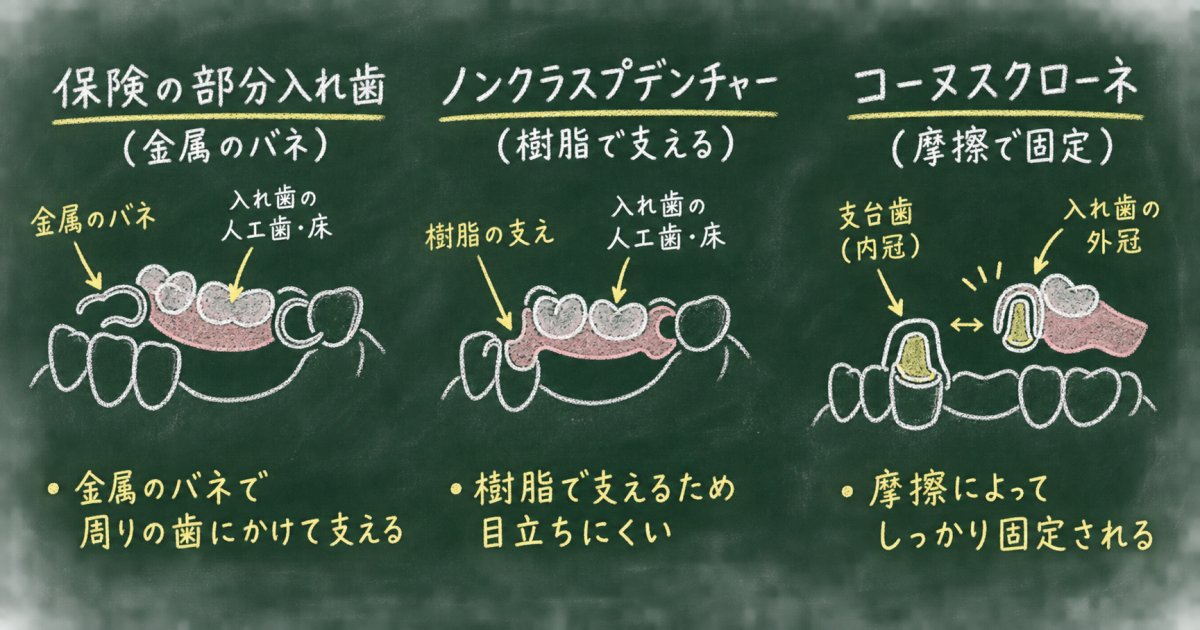 バネが目立ちにくい入れ歯にはどんな種類があるか